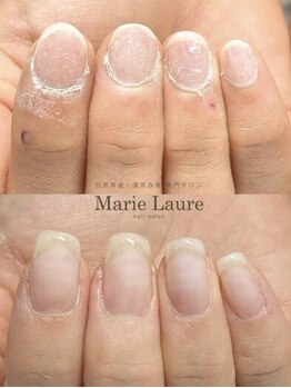 マリーロール 天王寺店(Marie Laure)/自爪育成/深爪矯正/ネイルケア