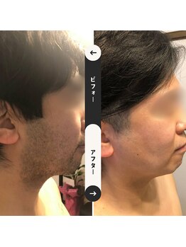 ジュゴン(Dugong)/メンズ脱毛（Before＆After）