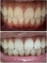 ラブホワイトニング 新宿店(LOVEホワイトニング)/セルフホワイトニング専門店