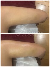 エルール トータルビューティ(Aileure total beauty)/術後DTケア　二の腕　１回施術