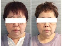 美容整体ウェリナ あま甚目寺院/.【小顔矯正before→after】