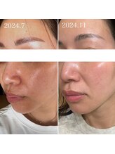 チェリッシュ(cherish)/くすみ肌・毛穴の開きにもハーブ