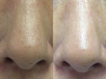 シロ(CHILO)/ハイドラ　before　after　２