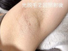 ピミル(PIMIL)/脇脱毛２回照射後
