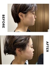 エリシオン(ELYSION)/RFリフトアップ