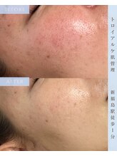 ヴィノ フクシマ(VINO fukushima)/毛穴の開き、赤み改善