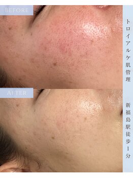 ヴィノ フクシマ(VINO fukushima)/毛穴の開き、赤み改善