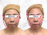 【たるみ改善】ほうれい線・口横ポニョを引き上げたい・リフトアップ
