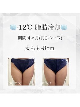 メディカルエステ 恵比寿店/*脂肪冷却 太もも症例*