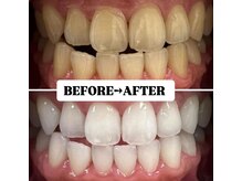 ホワイトニングサロン 豊中/Before&After美白ホワイトニング