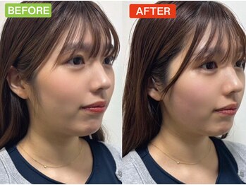 ヘッドミント/小顔矯正コルギ