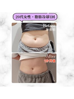 グランディールアン(GRANDIR UN)/【脂肪冷却】1カ月後