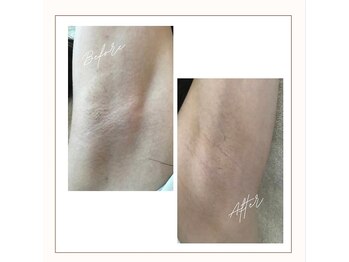 ラベニール(La Benir)/わき脱毛