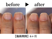 リング ザ ベル(ring the bell)/深爪スタンダードコース¥11,000