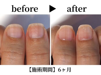 リング ザ ベル(ring the bell)/深爪スタンダードコース¥11,000