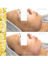 リアム(LiAm)/脂肪分解剤《レモンボトル》