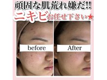 ホワイトアクア 天王寺本店(WHITE AQUA)/ハーブピーリング/大阪/天王寺