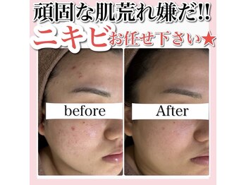 ホワイトアクア 天王寺本店(WHITE AQUA)/ハーブピーリング/大阪/天王寺