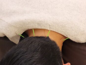 ポノ(Pono)/頭痛にも鍼が最適!