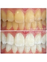 ホワイトニングルーム 横浜店(Whitening Room)/セルフホワイトニング/横浜