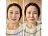 モニター様募集【韓国水光肌小顔】年齢を巻き戻す!美肌リフトフェイシャル
