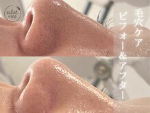 エクラリール(eclat rire)