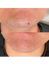 エン(enn)/【あご髭】