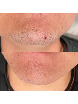 エン(enn)/【あご髭】