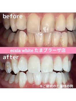 エクシアホワイトニング たまプラーザ店/ビフォーアフター