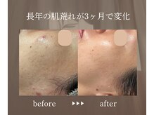 エメ(eme)/諦めていたお悩みも本来の美肌へ