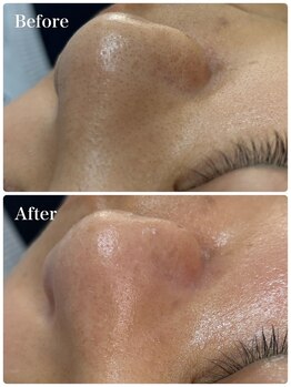 モテ 新宿店(Mote)/ハイドラ毛穴洗浄＋艶肌Wax 新宿