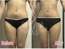 グラウディア 恵比寿/痩身/筋膜リリース/インディバ超