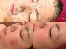 エステ ラミ(Esthe' l'ami)/REVI ハーブピーリング