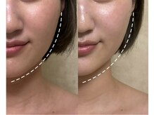 リフテグレース(LIFTE Grace)/小顔フェイシャル初回