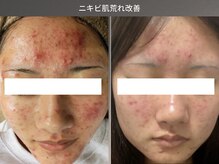 リラケア 三郷店/ニキビ肌荒れ改善