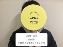 イエス 大阪梅田店(YES)/圧倒的！小鼻黒ずみ改善！