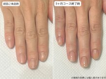 カピリナ(Ka Pilina)/自爪育成・川崎・深爪