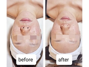 リラージェ 中目黒(Relaje)/※1回の施術効果before→After