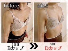 プリマ(prima)/バストアップ症例