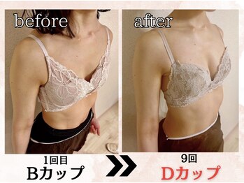 プリマ(prima)/バストアップ症例