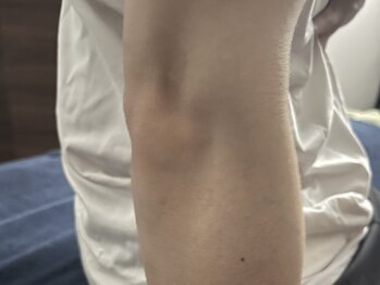 ミノシマ整体/肘内障の施術後