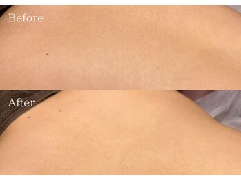 ミアンカ(mianca)/背中脱毛