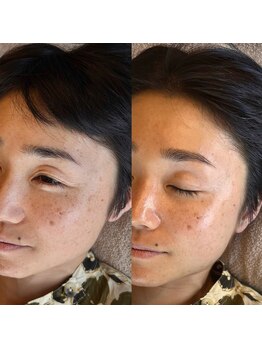 マナ ワクシング 海浜幕張(Mana waxing)/ツヤ肌wax/フェイシャルwax/幕張