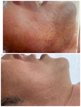 ティアレ 廿日市店(Tiare)/髭脱毛　ひげ　爆抜けモード