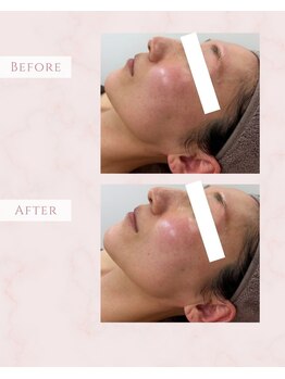 ルミナ(LUMINA)/光フェイシャルリフトアップ効果