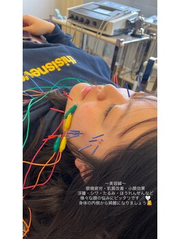 おはな整骨院 子飼橋院/☆美容鍼☆