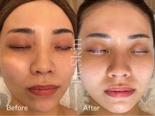 ビースキン 藤沢店(BeSkin)/韓国人のような水光肌作り♪