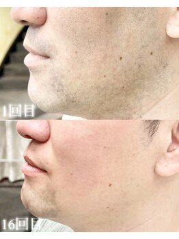 リノア(Linoa)の写真/ヒゲ脱毛を実際に体験したからこそ分かる不安や疑問、経過の変化も含めて丁寧にご説明できます！