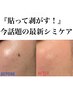 貼って剥がす!最新シミケア 【フェイシャル回数券のお客様限定】