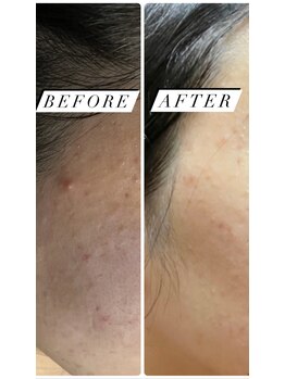 ツリービューティー(Tree Beauty)/★お肌トラブル改善!★